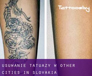 Usuwanie tatuaży w Other Cities in Slovakia