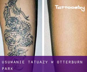 Usuwanie tatuaży w Otterburn Park