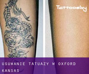 Usuwanie tatuaży w Oxford (Kansas)