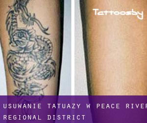 Usuwanie tatuaży w Peace River Regional District