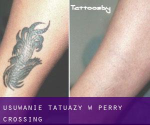 Usuwanie tatuaży w Perry Crossing