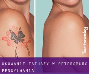 Usuwanie tatuaży w Petersburg (Pensylwania)