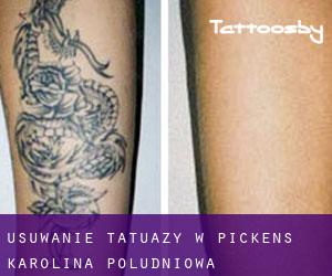 Usuwanie tatuaży w Pickens (Karolina Południowa)