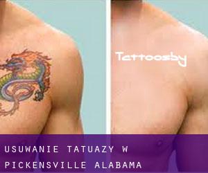 Usuwanie tatuaży w Pickensville (Alabama)