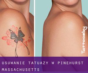 Usuwanie tatuaży w Pinehurst (Massachusetts)