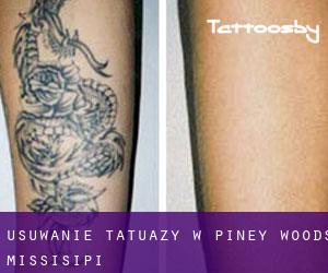 Usuwanie tatuaży w Piney Woods (Missisipi)