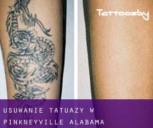 Usuwanie tatuaży w Pinkneyville (Alabama)
