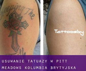 Usuwanie tatuaży w Pitt Meadows (Kolumbia Brytyjska)