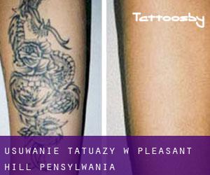 Usuwanie tatuaży w Pleasant Hill (Pensylwania)