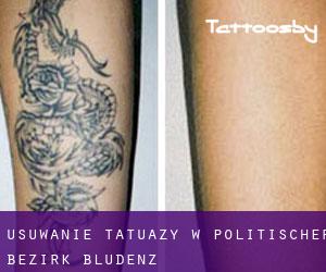 Usuwanie tatuaży w Politischer Bezirk Bludenz
