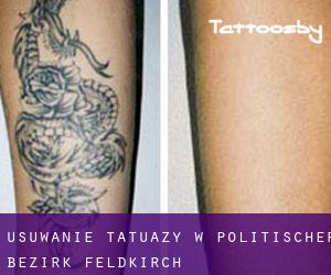 Usuwanie tatuaży w Politischer Bezirk Feldkirch