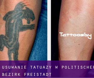 Usuwanie tatuaży w Politischer Bezirk Freistadt