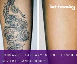 Usuwanie tatuaży w Politischer Bezirk Gänserndorf