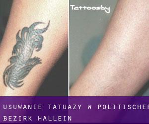 Usuwanie tatuaży w Politischer Bezirk Hallein