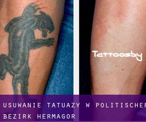 Usuwanie tatuaży w Politischer Bezirk Hermagor