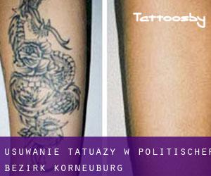 Usuwanie tatuaży w Politischer Bezirk Korneuburg