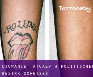 Usuwanie tatuaży w Politischer Bezirk Scheibbs