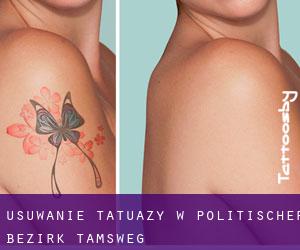 Usuwanie tatuaży w Politischer Bezirk Tamsweg
