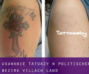 Usuwanie tatuaży w Politischer Bezirk Villach Land