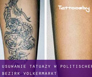 Usuwanie tatuaży w Politischer Bezirk Völkermarkt