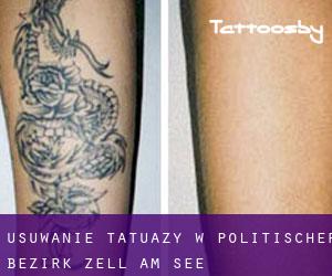 Usuwanie tatuaży w Politischer Bezirk Zell am See