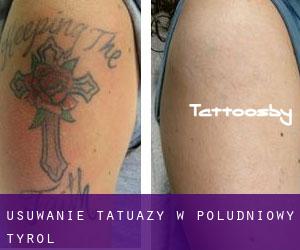 Usuwanie tatuaży w Południowy Tyrol