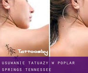 Usuwanie tatuaży w Poplar Springs (Tennessee)