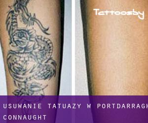 Usuwanie tatuaży w Portdarragh (Connaught)