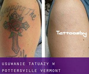Usuwanie tatuaży w Pottersville (Vermont)