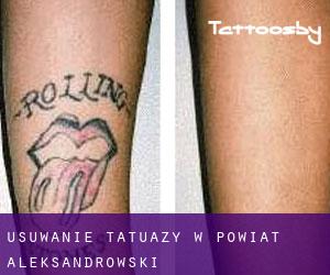 Usuwanie tatuaży w Powiat aleksandrowski