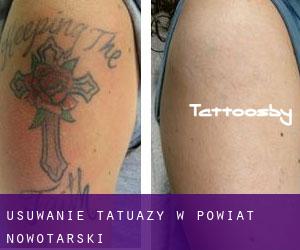 Usuwanie tatuaży w Powiat nowotarski