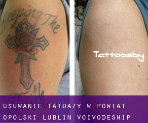 Usuwanie tatuaży w Powiat opolski (Lublin Voivodeship)
