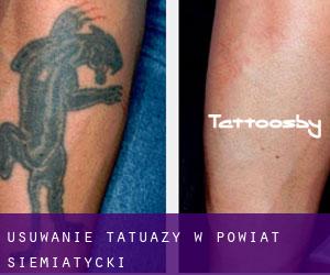 Usuwanie tatuaży w Powiat siemiatycki