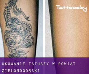 Usuwanie tatuaży w Powiat zielonogórski