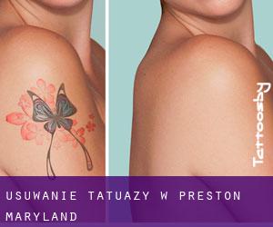 Usuwanie tatuaży w Preston (Maryland)