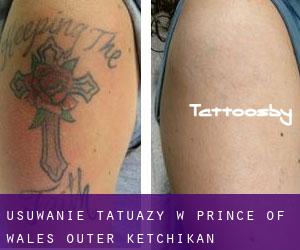 Usuwanie tatuaży w Prince of Wales-Outer Ketchikan