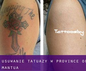 Usuwanie tatuaży w Province of Mantua