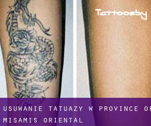 Usuwanie tatuaży w Province of Misamis Oriental