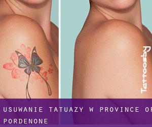 Usuwanie tatuaży w Province of Pordenone