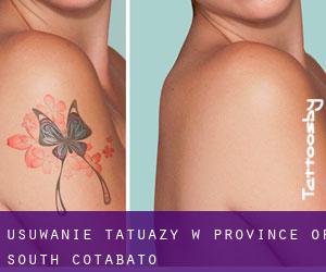 Usuwanie tatuaży w Province of South Cotabato