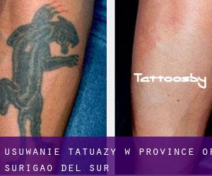Usuwanie tatuaży w Province of Surigao del Sur