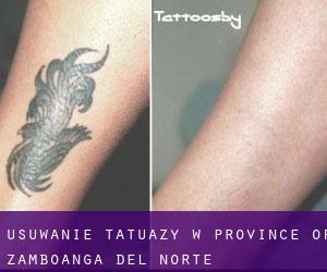 Usuwanie tatuaży w Province of Zamboanga del Norte