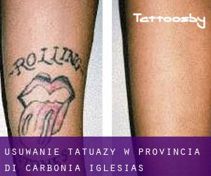 Usuwanie tatuaży w Provincia di Carbonia-Iglesias