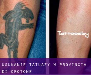Usuwanie tatuaży w Provincia di Crotone
