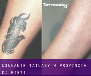 Usuwanie tatuaży w Provincia di Rieti