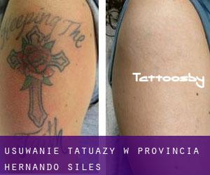 Usuwanie tatuaży w Provincia Hernando Siles
