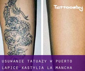 Usuwanie tatuaży w Puerto Lápice (Kastylia-La Mancha)