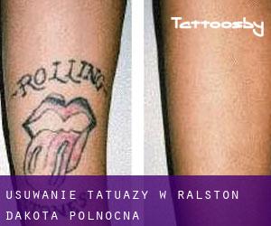 Usuwanie tatuaży w Ralston (Dakota Północna)