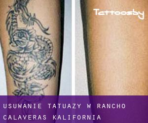 Usuwanie tatuaży w Rancho Calaveras (Kalifornia)