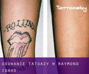 Usuwanie tatuaży w Raymond (Idaho)